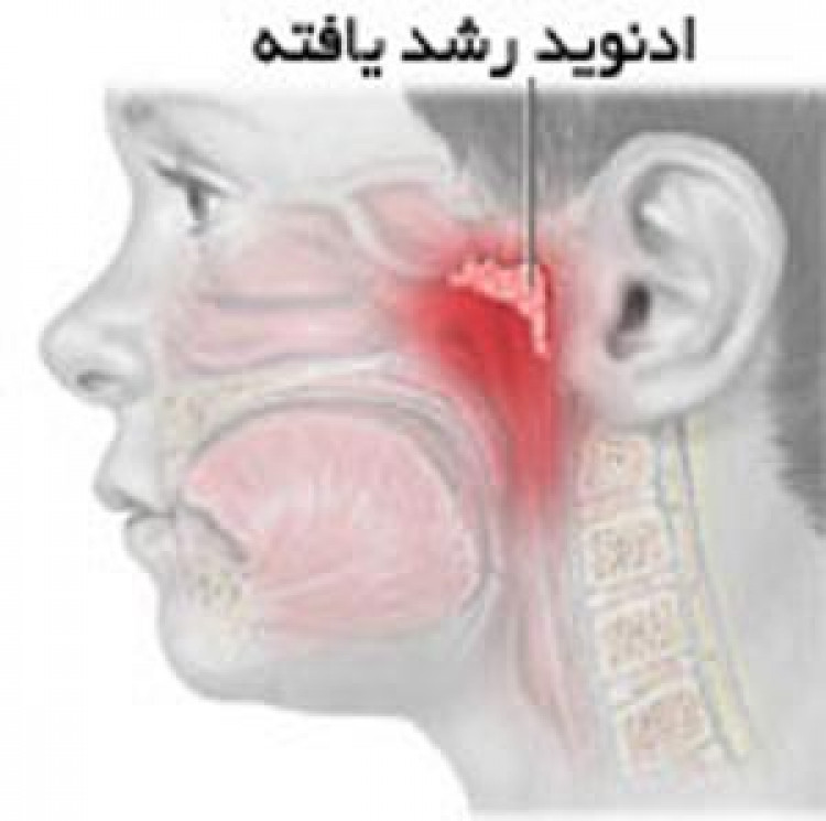 پاورپوینت آدنوئید یا لوزه سوم چیست