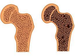 پاورپوینت ریکتز، استئومالاسی و استئوپروز